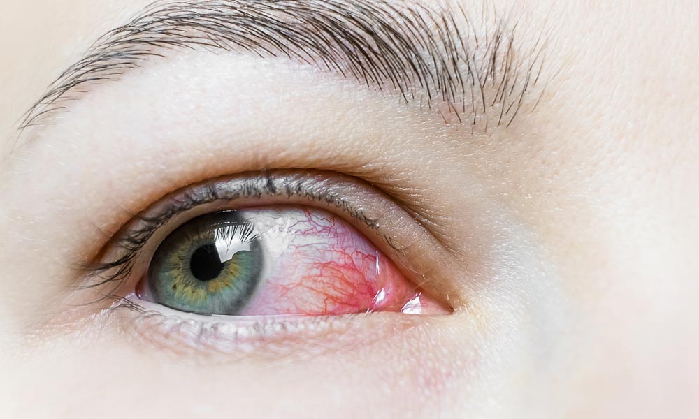 Comprehensive Care for Eye Infections