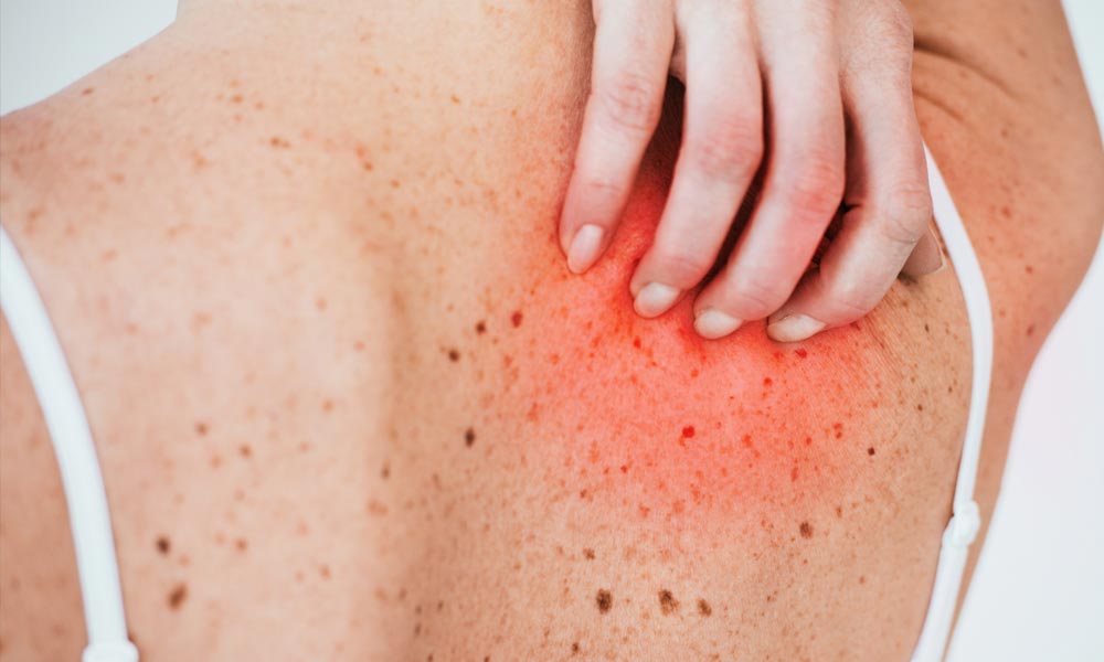 Treatment for Rashes